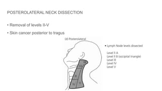 POSTEROLATERAL NECK DISSECTION
• Removal of levels II-V
• Skin cancer posterior to tragus
 