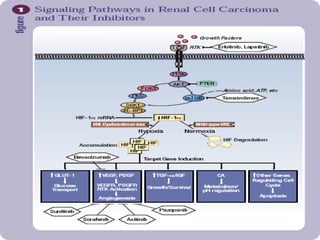 Metastatic renal cell carcinoma | PPTX