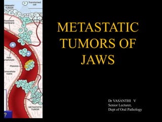 METASTATIC
TUMORS OF
JAWS
Dr VASANTHI V
Senior Lecturer,
Dept of Oral Pathology
 