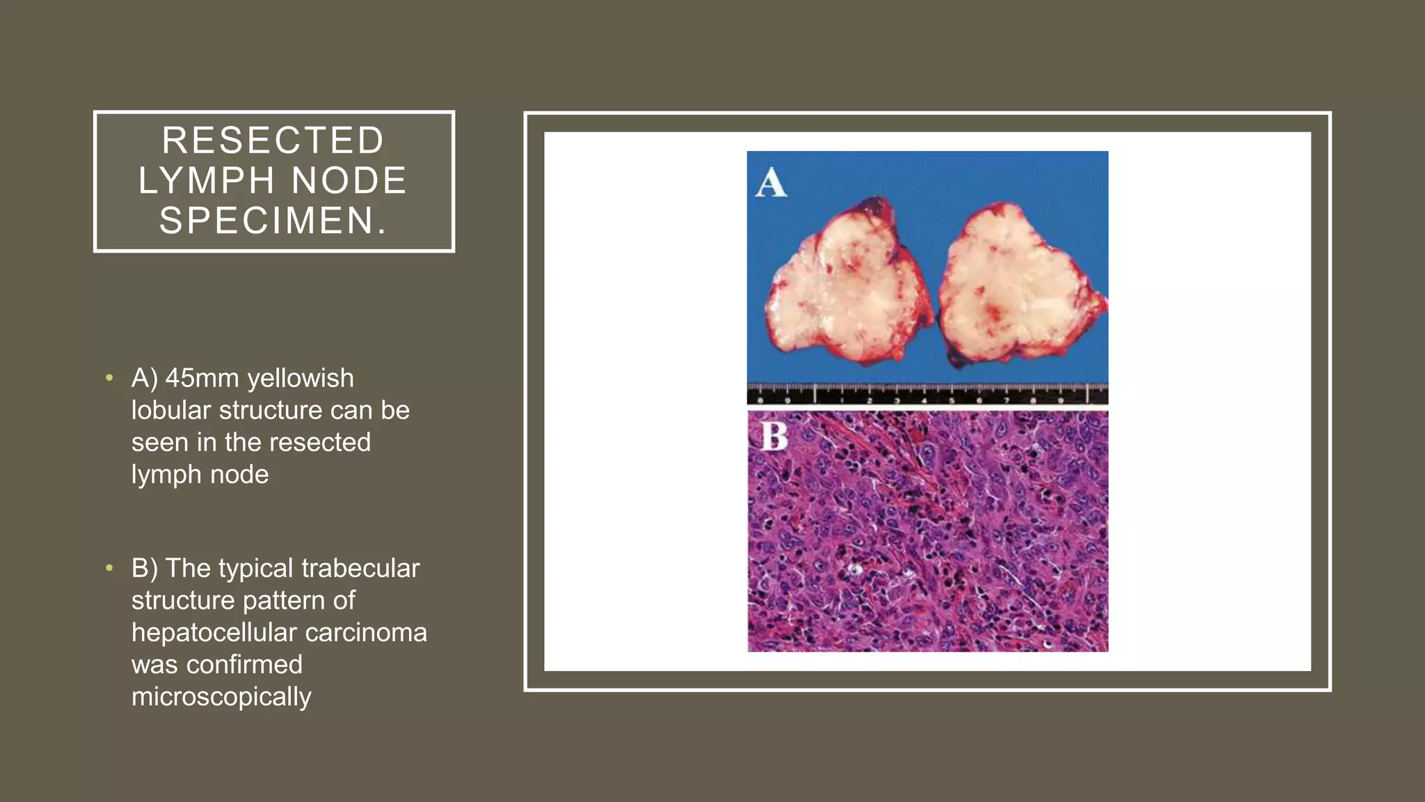 RESECTED
LYMPH NODE
SPECIMEN.
• A) 45mm yellowish
lobular structure can be
seen in the resected
lymph node
• B) The typical trabecular
structure pattern of
hepatocellular carcinoma
was confirmed
microscopically
 