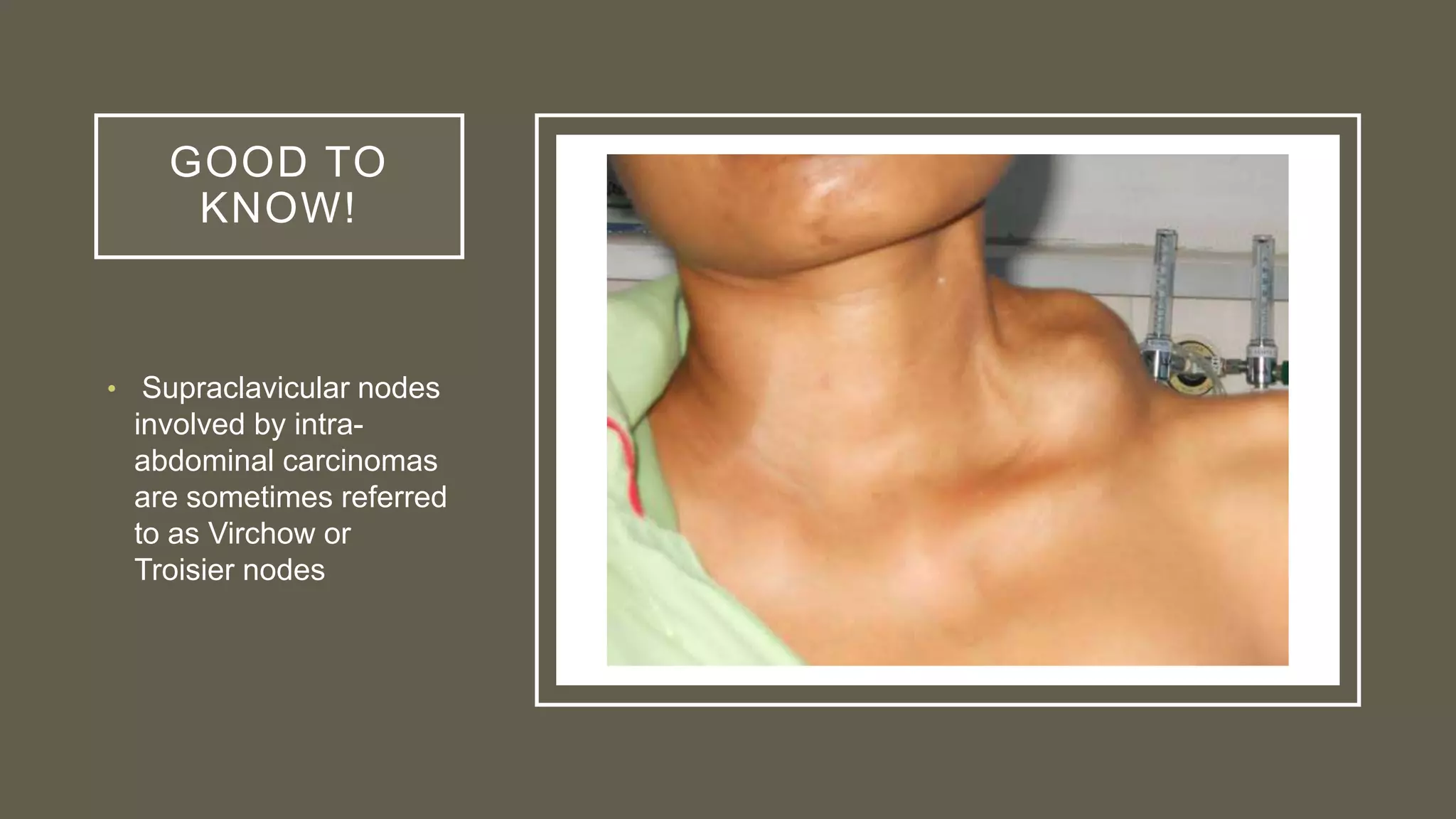 GOOD TO
KNOW!
• Supraclavicular nodes
involved by intra-
abdominal carcinomas
are sometimes referred
to as Virchow or
Troisier nodes
 