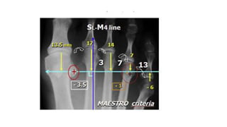 Humnt metatarsalgias HUMNT.pptx descripcion de patología | PPTX