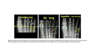 Humnt metatarsalgias HUMNT.pptx descripcion de patología | PPTX