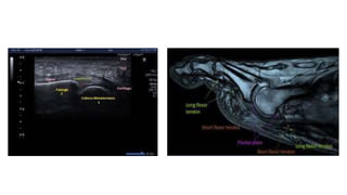 Humnt metatarsalgias HUMNT.pptx descripcion de patología | PPTX