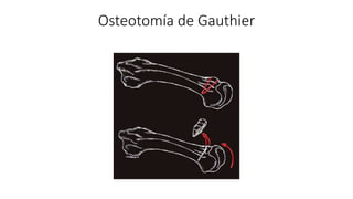 Humnt metatarsalgias HUMNT.pptx descripcion de patología | PPTX