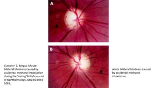 Acute bilateral blindness caused
by accidental methanol
intoxication
Cursiefen C, Bergua AAcute
bilateral blindness caused by
accidental methanol intoxication
during fire "eating"British Journal
of Ophthalmology 2002;86:1064-
1065.
 