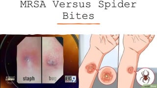 MRSA Versus Spider
Bites
 