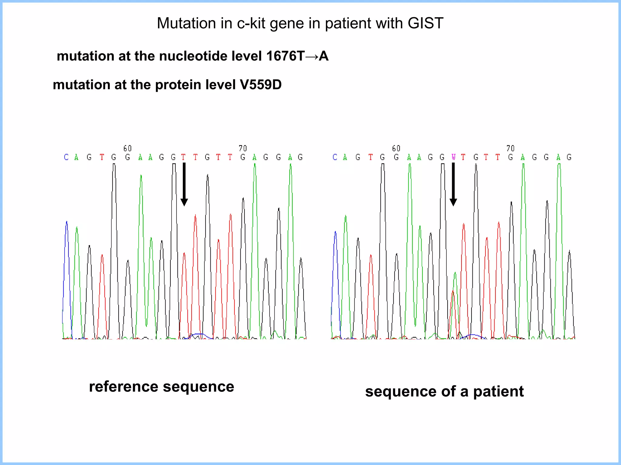 Mutation in c-kit gene in patient with GIST  reference sequence sequence of a patient mutation at the nucleotide level  1676T->A mutation at the protein level V 55 9D 