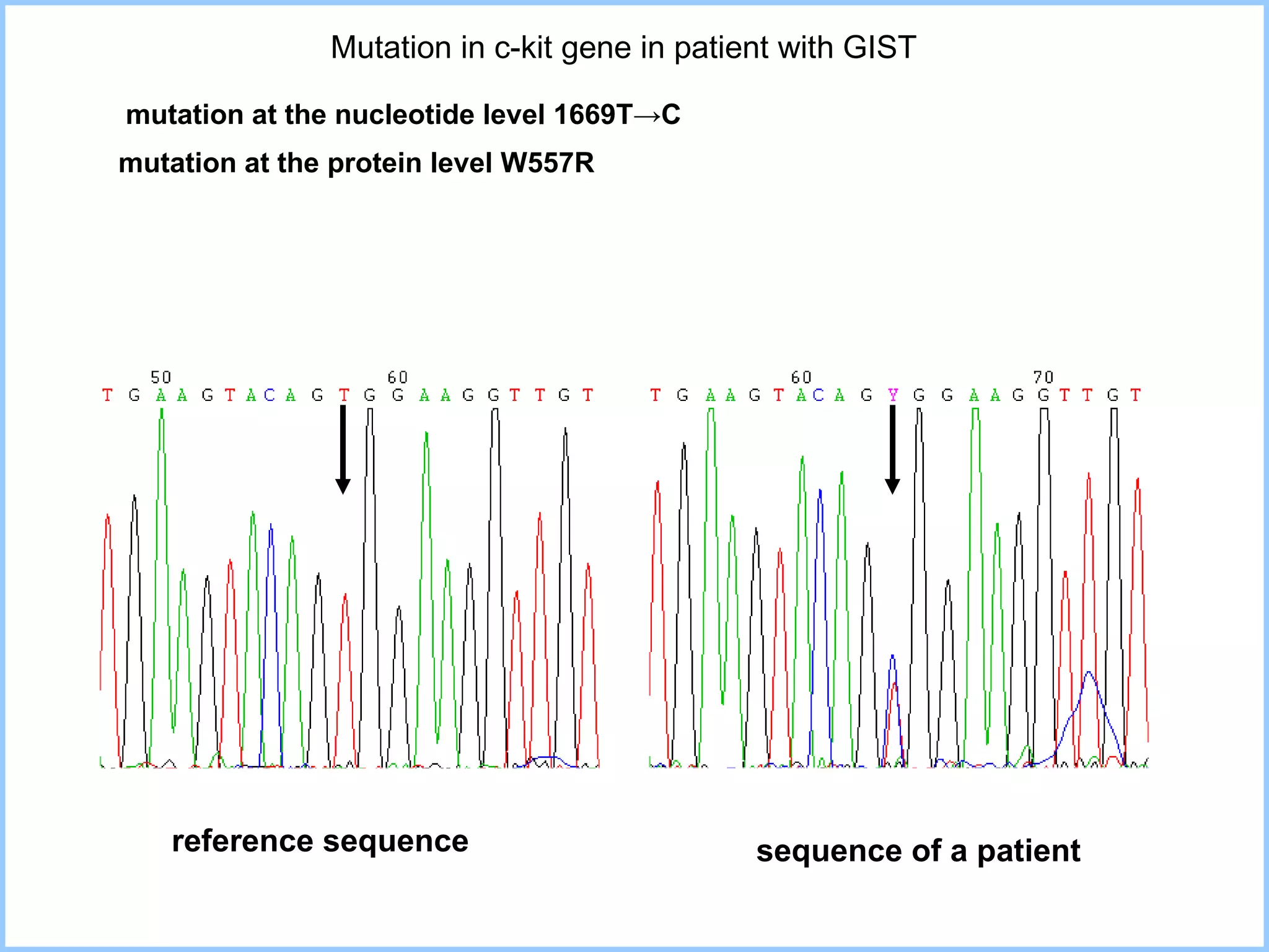 Mutation in c-kit gene in patient with GIST  mutation at the nucleotide level  1669T->C mutation at the protein level W 557R reference sequence sequence of a patient 