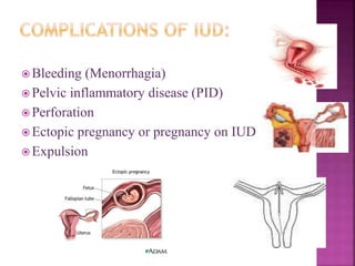  Bleeding (Menorrhagia)
 Pelvic inflammatory disease (PID)
 Perforation
 Ectopic pregnancy or pregnancy on IUD
 Expulsion
 