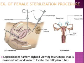  Laparoscope: narrow, lighted viewing instrument that is
inserted into abdomen to locate the fallopian tubes
 