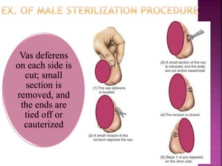 Vas deferens
on each side is
cut; small
section is
removed, and
the ends are
tied off or
cauterized
 