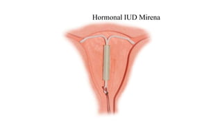 Hormonal IUD Mirena
 