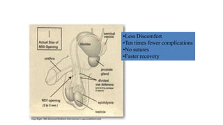 •Less Discomfort
•Ten times fewer complications
•No sutures
•Faster recovery
 