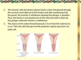 4. The inserter with the device placed inside is then introduced through
the cervical canal right up to the fundus and after positioning it by
the guard, the inserter is withdrawn keeping the plunger in position.
Thus, the device is not pushed out of the tube but held in place by
the plunger while the inserter is withdrawn.
5. The excess of the nylon thread beyound 2-3 cm from the external os
is cut. Then the allis forceps and the posterior vaginal speculum are
taken off.
 