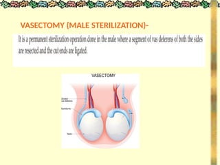 VASECTOMY (MALE STERILIZATION)-
 