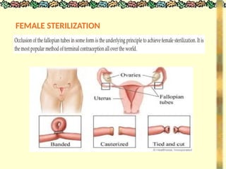 FEMALE STERILIZATION
 