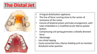 Distalisation Jet Methods of gaining space | PPTX