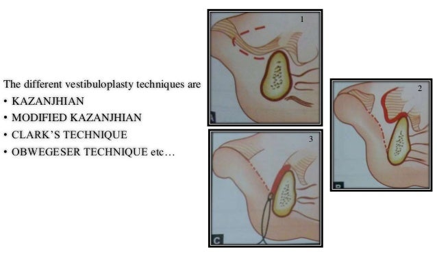 vestibuloplasty indications methods to improve lete denture foundation 2 vestibuloplasty indications methods to improve lete denture foundation 2