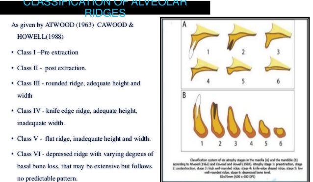 classification of edentulous ridge