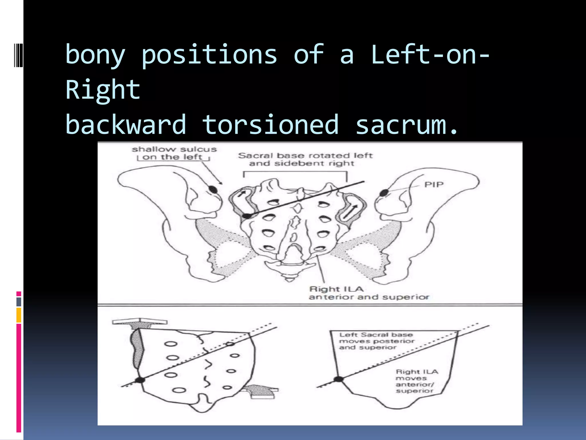 bony positions of a Left-on-
Right
backward torsioned sacrum.
 