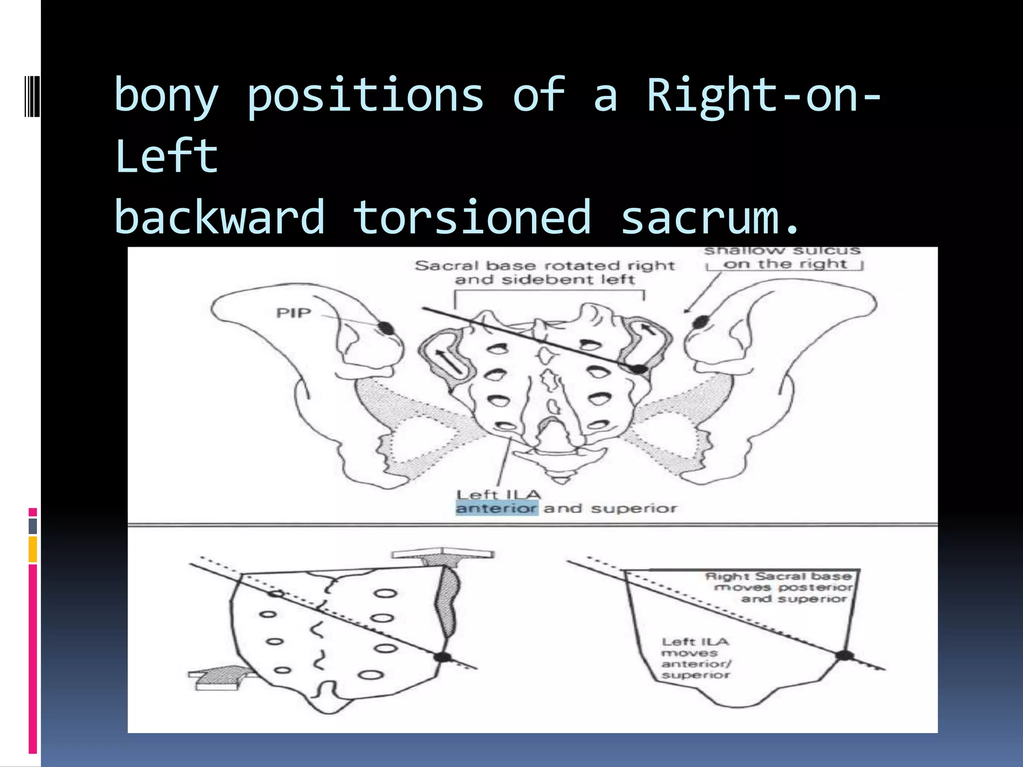bony positions of a Right-on-
Left
backward torsioned sacrum.
 