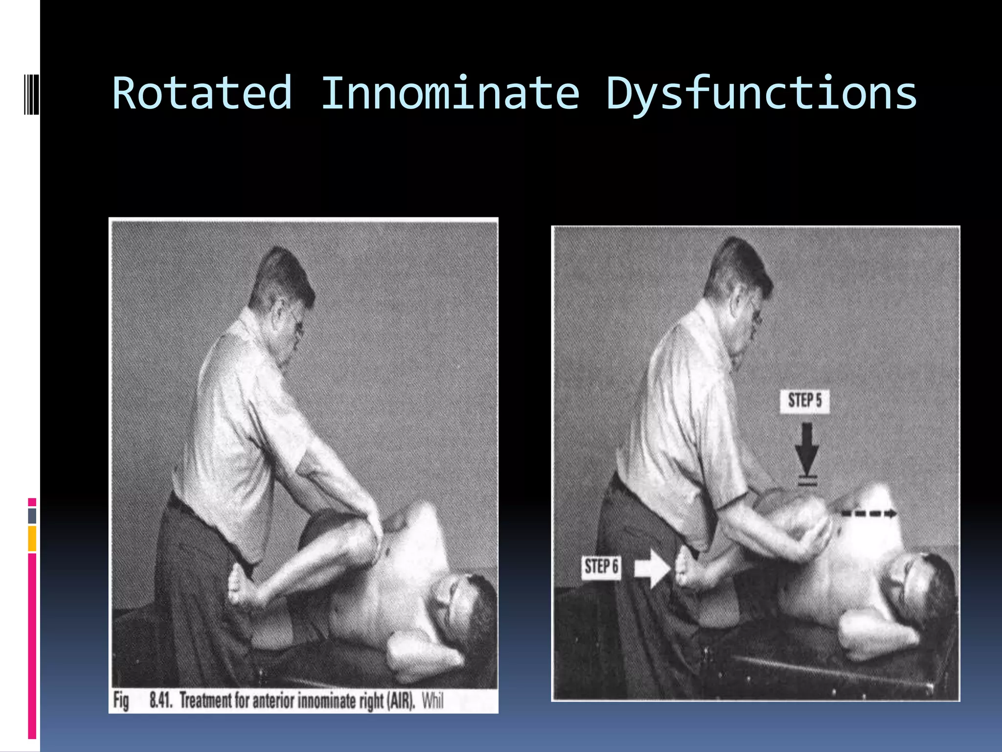 Rotated Innominate Dysfunctions
 