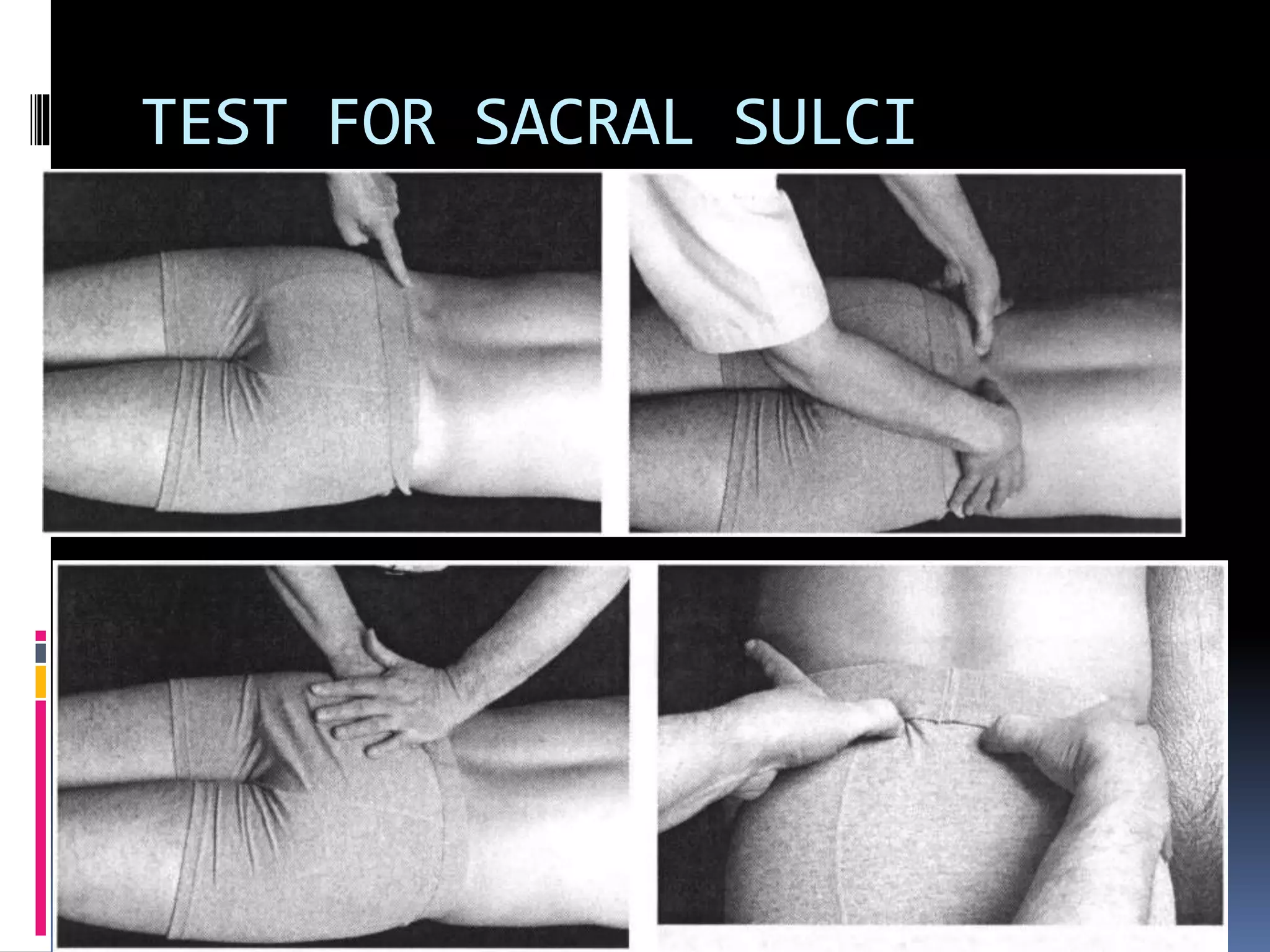 TEST FOR SACRAL SULCI
 