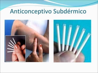 Anticonceptivo Subdérmico 