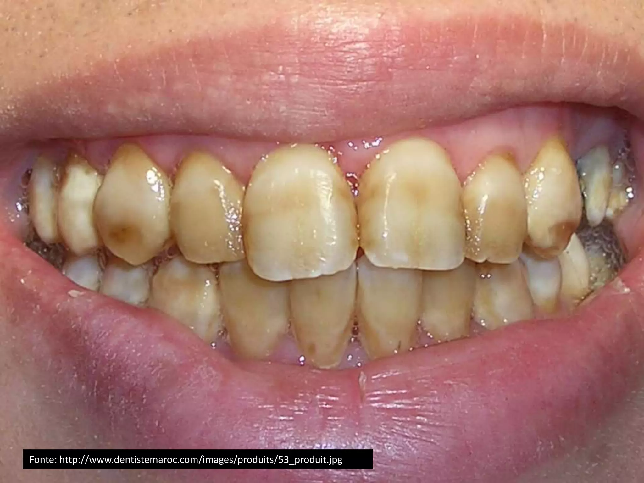 Fonte: http://www.dentistemaroc.com/images/produits/53_produit.jpg
 