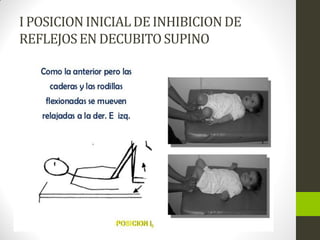 I POSICIONINICIALDEINHIBICIONDE
REFLEJOSEN DECUBITOSUPINO
 