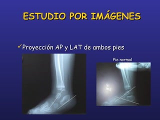 Proyección AP y LAT de ambos piesProyección AP y LAT de ambos pies
Pie normalPie normal
ESTUDIO POR IMÁGENESESTUDIO POR IMÁGENES
 