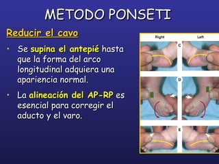 METODO PONSETIMETODO PONSETI
Reducir el cavoReducir el cavo
• SeSe supina el antepiésupina el antepié hastahasta
que la forma del arcoque la forma del arco
longitudinal adquiera unalongitudinal adquiera una
apariencia normal.apariencia normal.
• LaLa alineación del AP-RPalineación del AP-RP eses
esencial para corregir elesencial para corregir el
aducto y el varo.aducto y el varo.
 
