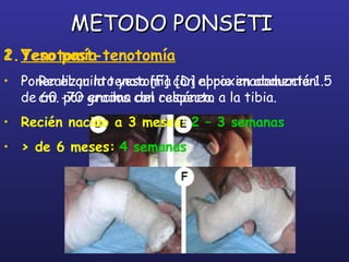 METODO PONSETIMETODO PONSETI
1.Tenotomía
• Realizar la tenotomía [D] aproximadamente 1.5
cm. por encima del calcáneo.
2.Yeso post-tenotomía
• Poner el quinto yeso [F] con el pie en abducción
de 60 -70 grados con respecto a la tibia.
• Recién nacido a 3 meses: 2 – 3 semanas
• > de 6 meses: 4 semanas
 