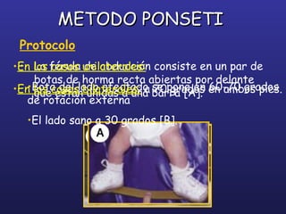 METODO PONSETIMETODO PONSETI
Protocolo
• La férula de abducción consiste en un par de
botas de horma recta abiertas por delante
que están unidas a una barra [A].
•En los casos unilaterales:
•Bota del lado afectado se pone en 60-70 grados
de rotación externa
•El lado sano a 30 grados [B].
•En los casos bilaterales: a 70 grados en ambos pies.
 