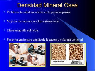 Densidad Mineral Osea ,[object Object],[object Object],[object Object],[object Object]
