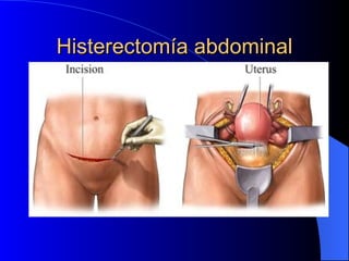 Histerectomía abdominal 