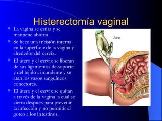 Histerectomía vaginal ,[object Object],[object Object],[object Object],[object Object]