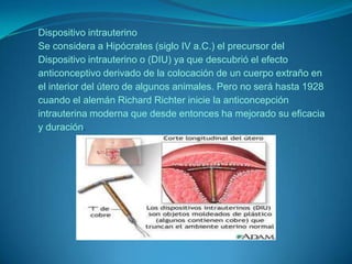 Dispositivo intrauterinoSe considera a Hipócrates (siglo IV a.C.) el precursor del Dispositivo intrauterino o (DIU) ya que descubrió el efecto anticonceptivo derivado de la colocación de un cuerpo extraño en el interior del útero de algunos animales. Pero no será hasta 1928 cuando el alemán Richard Richter inicie la anticoncepción intrauterina moderna que desde entonces ha mejorado su eficacia y duración.