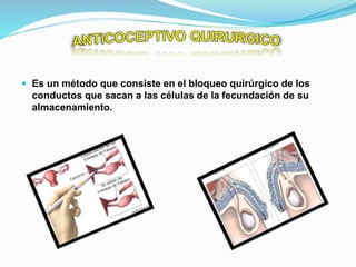  Es un método que consiste en el bloqueo quirúrgico de los
conductos que sacan a las células de la fecundación de su
almacenamiento.
 