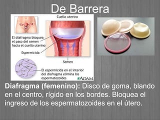 De Barrera
Diafragma (femenino): Disco de goma, blando
en el centro, rígido en los bordes. Bloquea el
ingreso de los espermatozoides en el útero.
 
