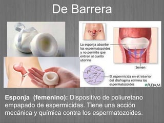 De Barrera
Esponja (femenino): Dispositivo de poliuretano
empapado de espermicidas. Tiene una acción
mecánica y química contra los espermatozoides.
 
