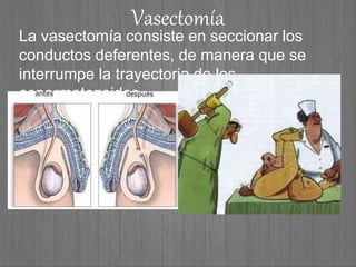 Vasectomía
La vasectomía consiste en seccionar los
conductos deferentes, de manera que se
interrumpe la trayectoria de los
espermatozoides.
 