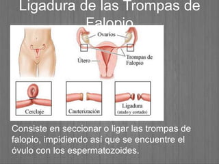 Ligadura de las Trompas de
Falopio
Consiste en seccionar o ligar las trompas de
falopio, impidiendo así que se encuentre el
óvulo con los espermatozoides.
 