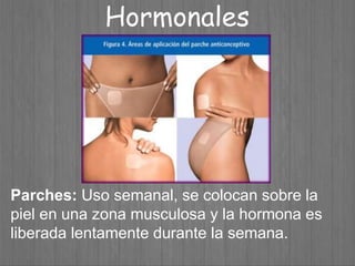 Parches: Uso semanal, se colocan sobre la
piel en una zona musculosa y la hormona es
liberada lentamente durante la semana.
Hormonales
 