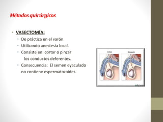 Métodosquirúrgicos
• VASECTOMÍA:
• De práctica en el varón.
• Utilizando anestesia local.
• Consiste en: cortar o pinzar
los conductos deferentes.
• Consecuencia: El semen eyaculado
no contiene espermatozoides.
 