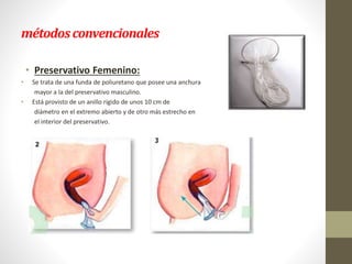 métodosconvencionales
• Preservativo Femenino:
• Se trata de una funda de poliuretano que posee una anchura
mayor a la del preservativo masculino.
• Está provisto de un anillo rígido de unos 10 cm de
diámetro en el extremo abierto y de otro más estrecho en
el interior del preservativo.
 