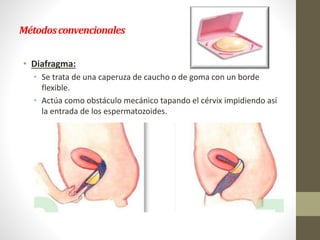 Métodosconvencionales
• Diafragma:
• Se trata de una caperuza de caucho o de goma con un borde
flexible.
• Actúa como obstáculo mecánico tapando el cérvix impidiendo así
la entrada de los espermatozoides.
 