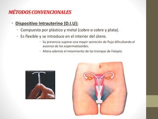 MÉTODOSCONVENCIONALES
• Dispositivo Intrauterino (D.I.U):
• Compuesto por plástico y metal (cobre o cobre y plata).
• Es flexible y se introduce en el interior del útero.
• Su presencia supone una mayor secreción de flujo dificultando el
ascenso de los espermatozoides.
• Altera además el movimiento de las trompas de Falopio.
 