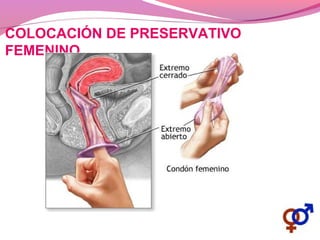 COLOCACIÓN DE PRESERVATIVO
FEMENINO
 